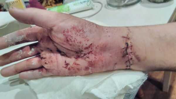 Рука перед операцией