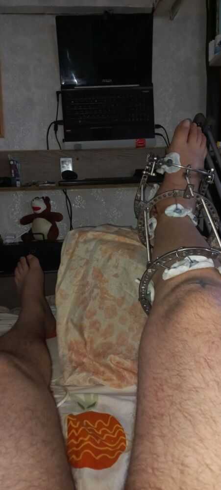 Установленный аппарат Илизарова